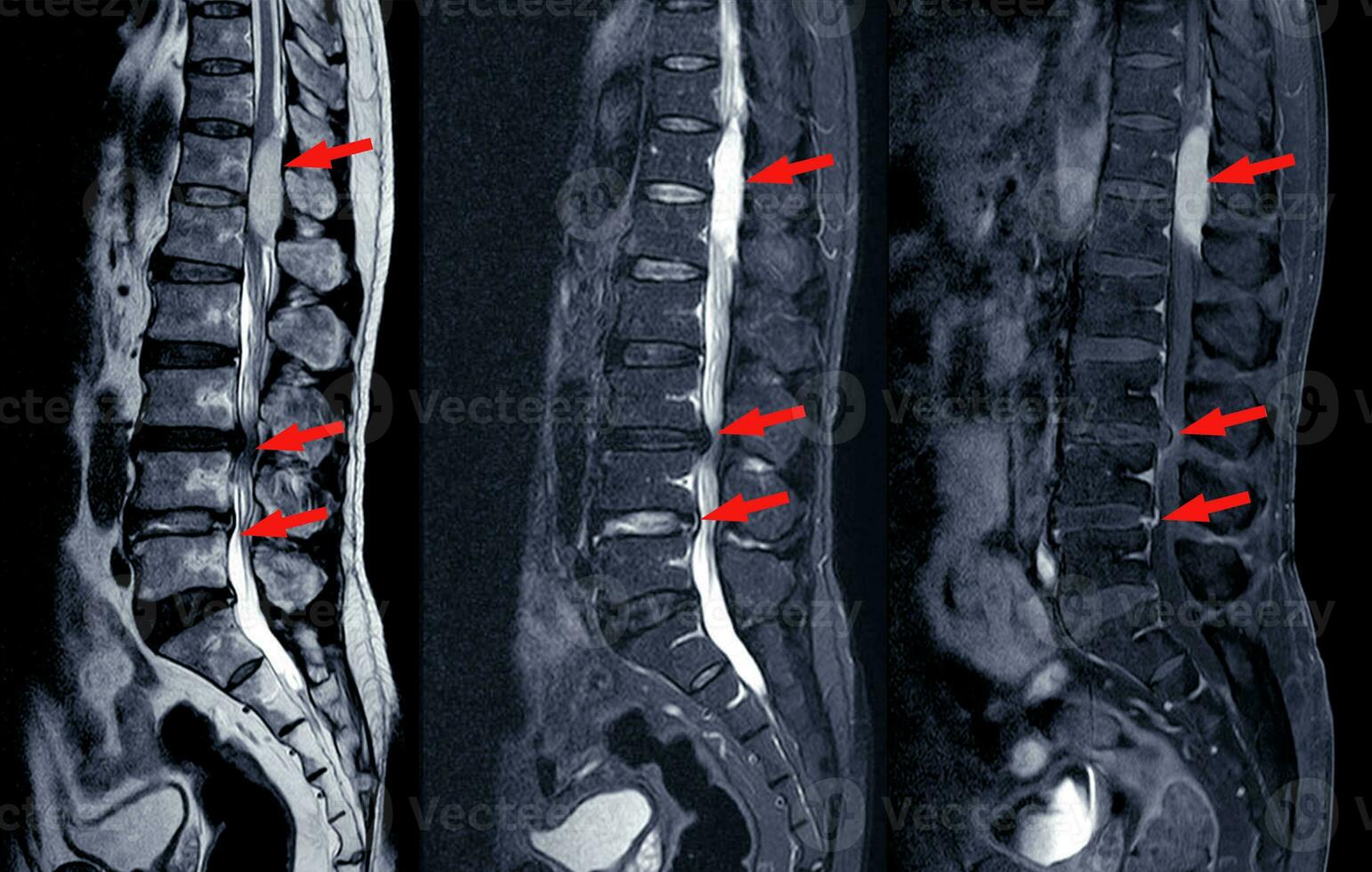 MRI scan of lumbar spines of a patient finding Spinal mass at Lt.side T12-L1 level Severe bulging disc L3-4 causing bilateral L4 nerve root compression  and spinal stenosis on arrow point. photo