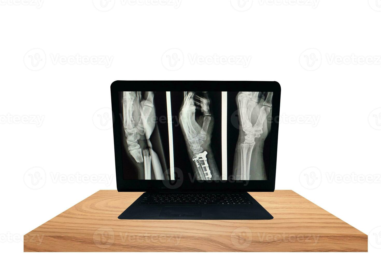 X-ray Left wrist fracture distal metaphysis of both bones forearm.Dorsol displacement of distal fragments.Severe swelling of soft tissue.Medical image concept. photo