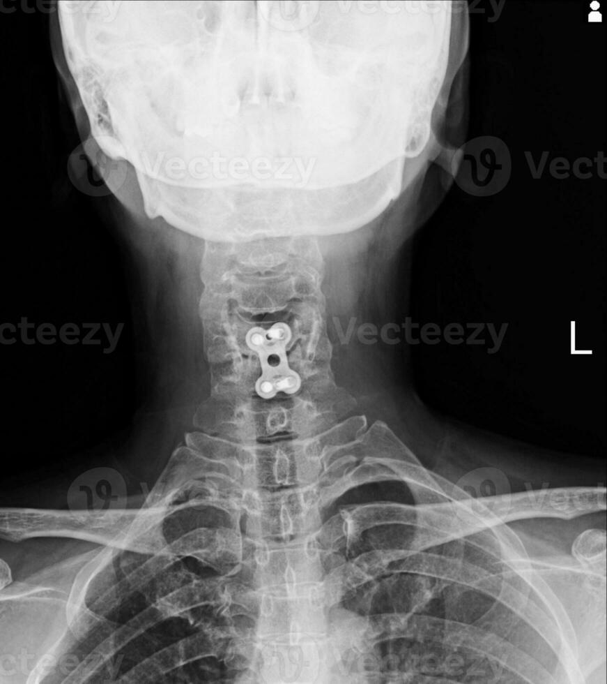 c-columna radiografía espinal ficación de c5-6 cuerpos No espinal dislocación foto