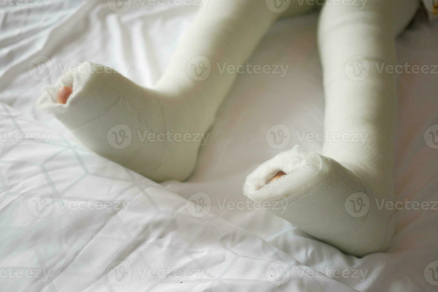 little child with plaster bandage on leg. photo