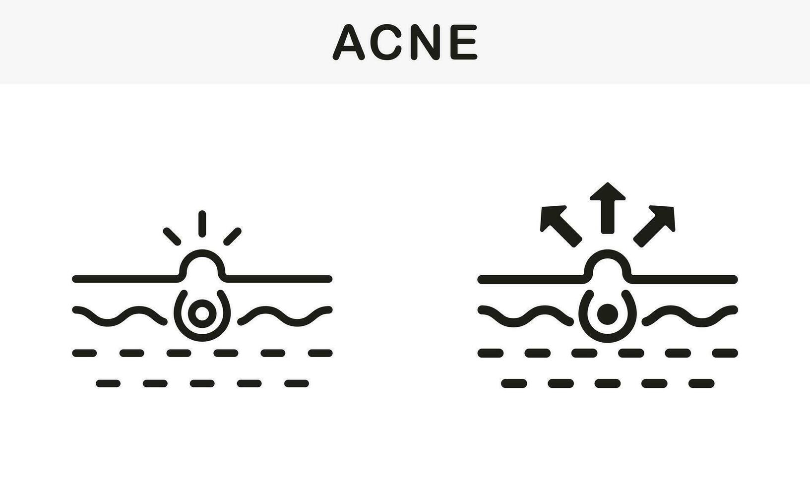 piel acné, espinilla, comedón línea y silueta negro icono colocar. espinilla y inflamación sebo pictograma. profundo sucio poro, piel problema símbolo recopilación. aislado vector ilustración.