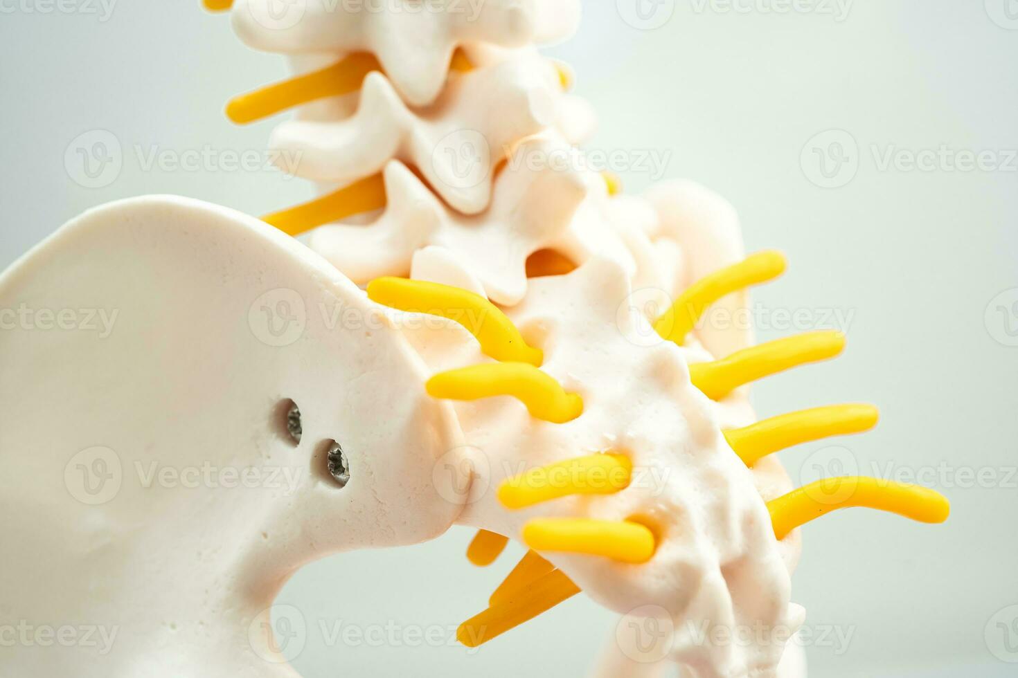 Lumbar spine displaced herniated disc fragment, spinal nerve and bone. Model for treatment medical in the orthopedic department. photo