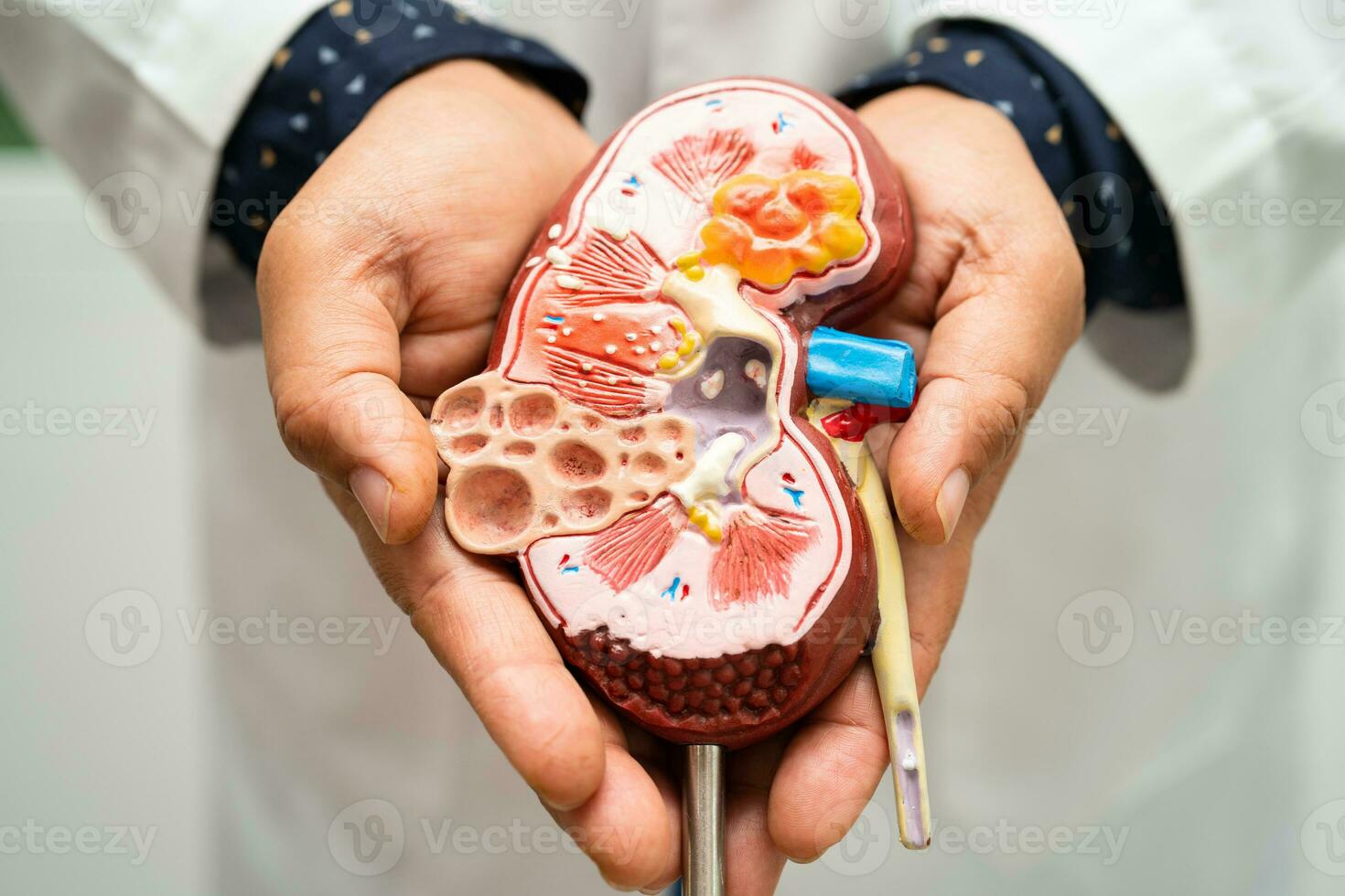 Kidney disease, Chronic kidney disease ckd, Doctor hold model to study and treat in hospital. photo