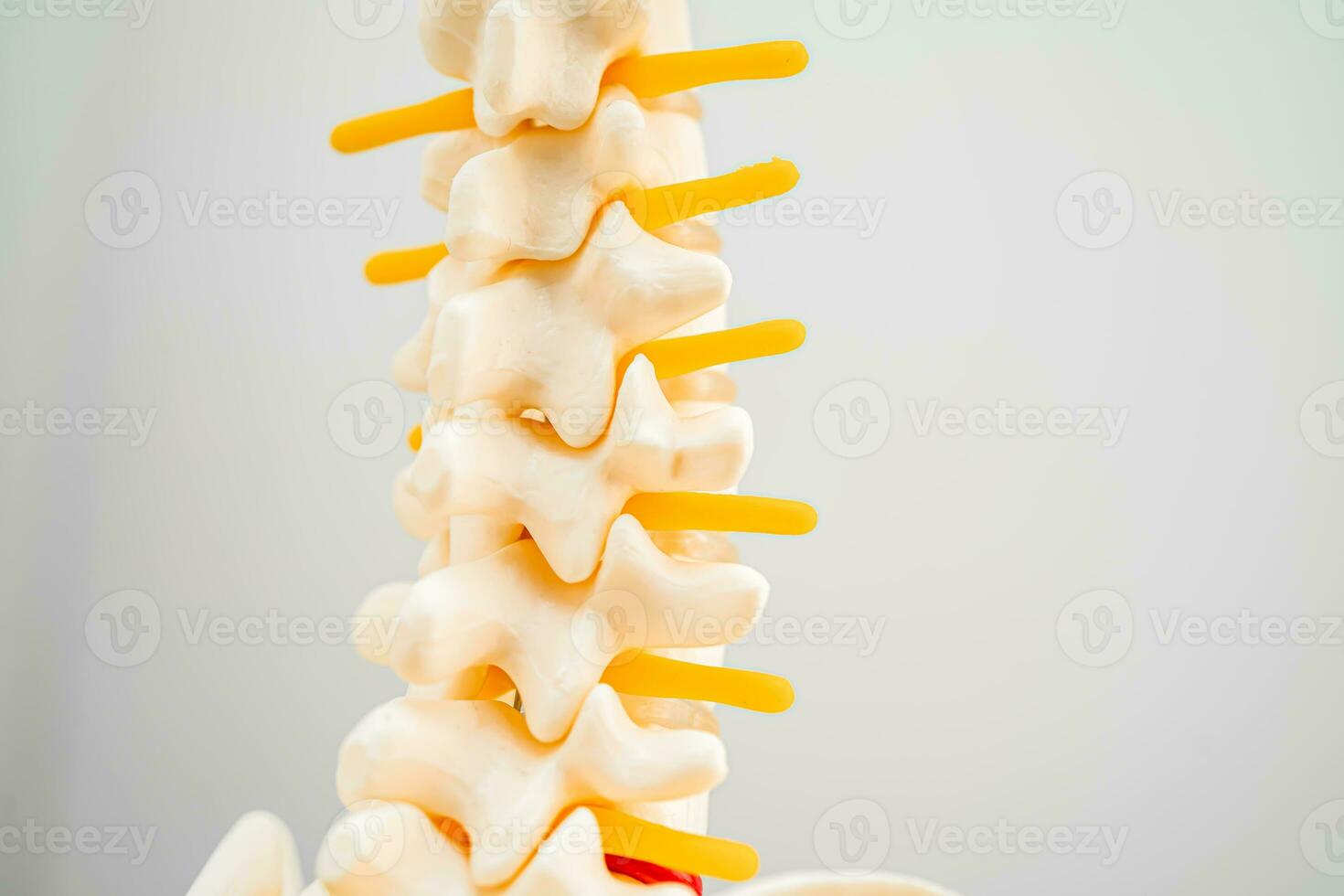 Lumbar spine displaced herniated disc fragment, spinal nerve and bone. Model for treatment medical in the orthopedic department. photo