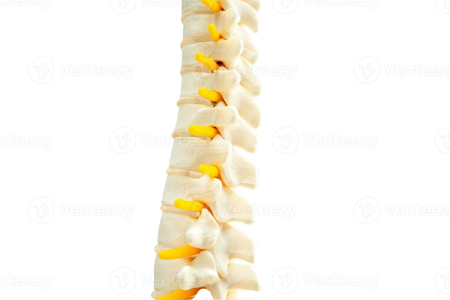 Lumbar spine displaced herniated disc fragment, spinal nerve and bone. Model for treatment medical in the orthopedic department. photo