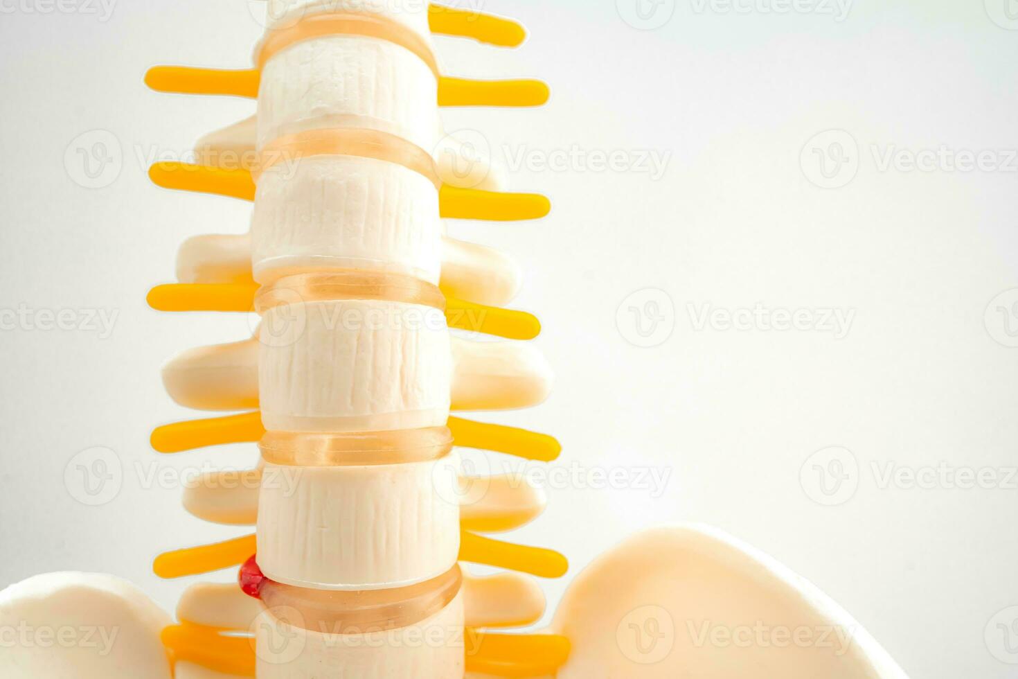 Lumbar spine displaced herniated disc fragment, spinal nerve and bone. Model for treatment medical in the orthopedic department. photo