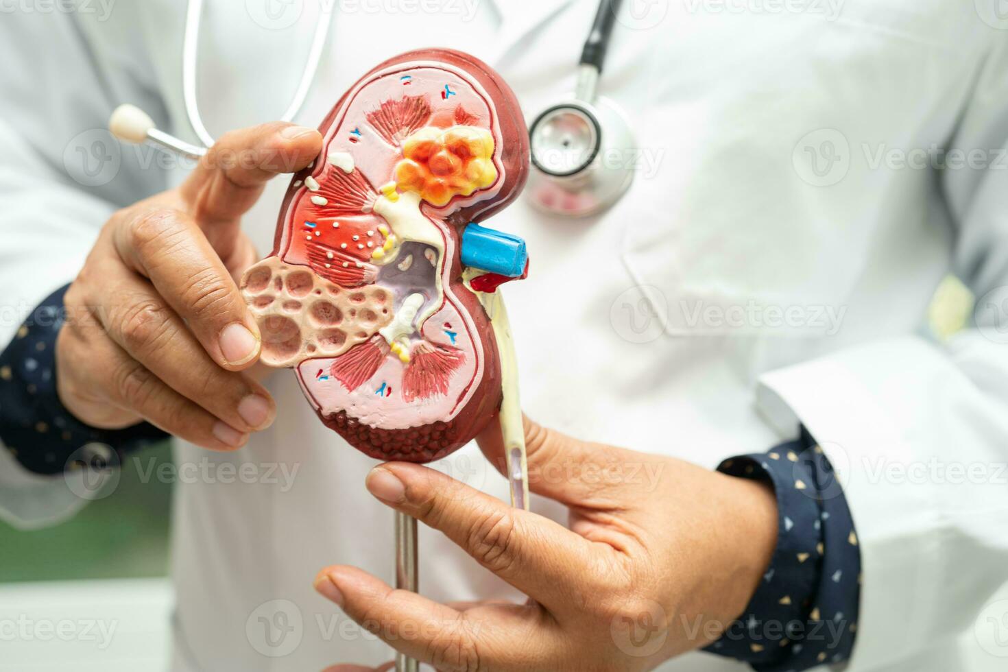 Kidney disease, Chronic kidney disease ckd, Doctor hold model to study and treat in hospital. photo