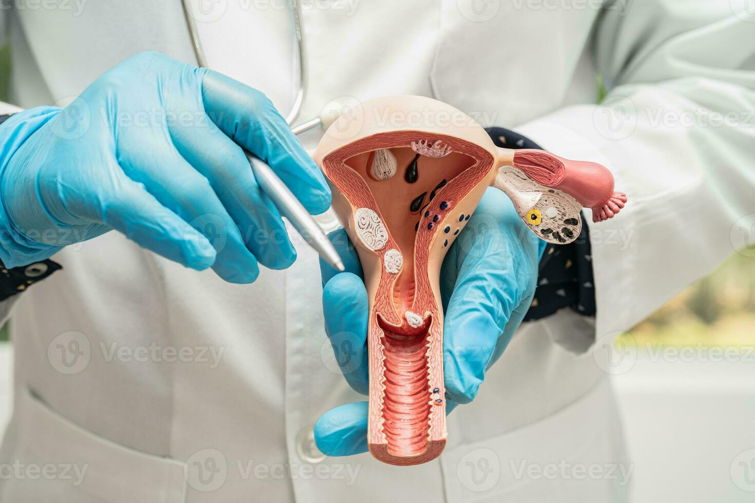 Uterus, doctor holding anatomy model for study diagnosis and treatment in hospital. photo