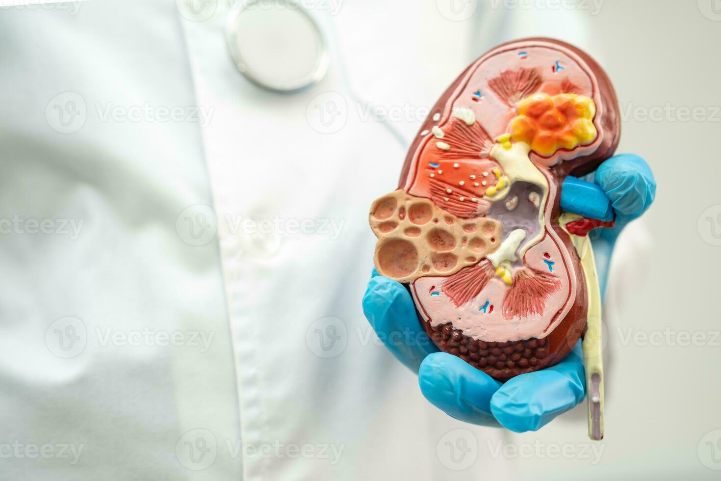 Kidney disease, Chronic kidney disease ckd, Doctor hold model to study and treat in hospital. photo