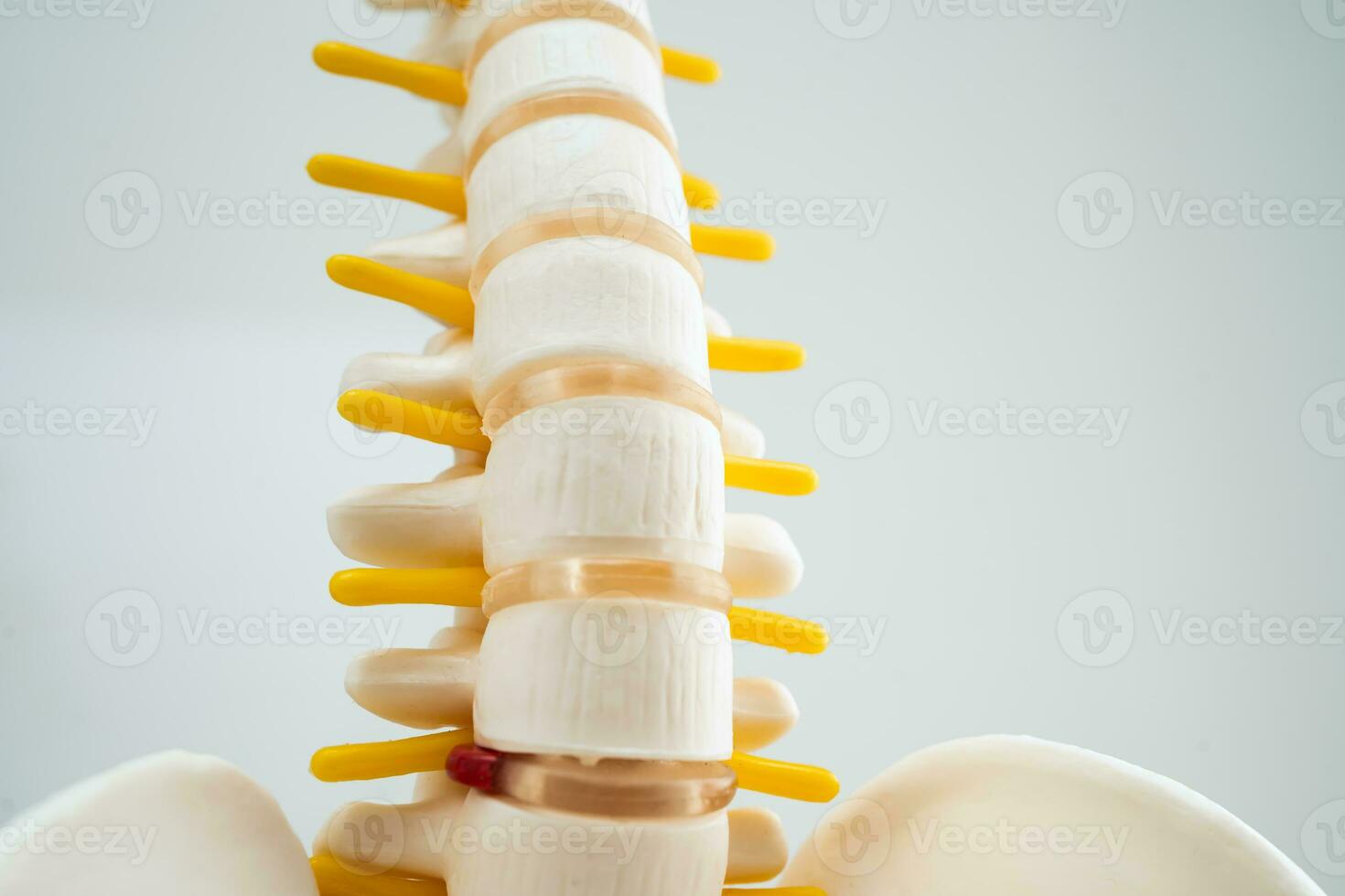 Lumbar spine displaced herniated disc fragment, spinal nerve and bone. Model for treatment medical in the orthopedic department. photo