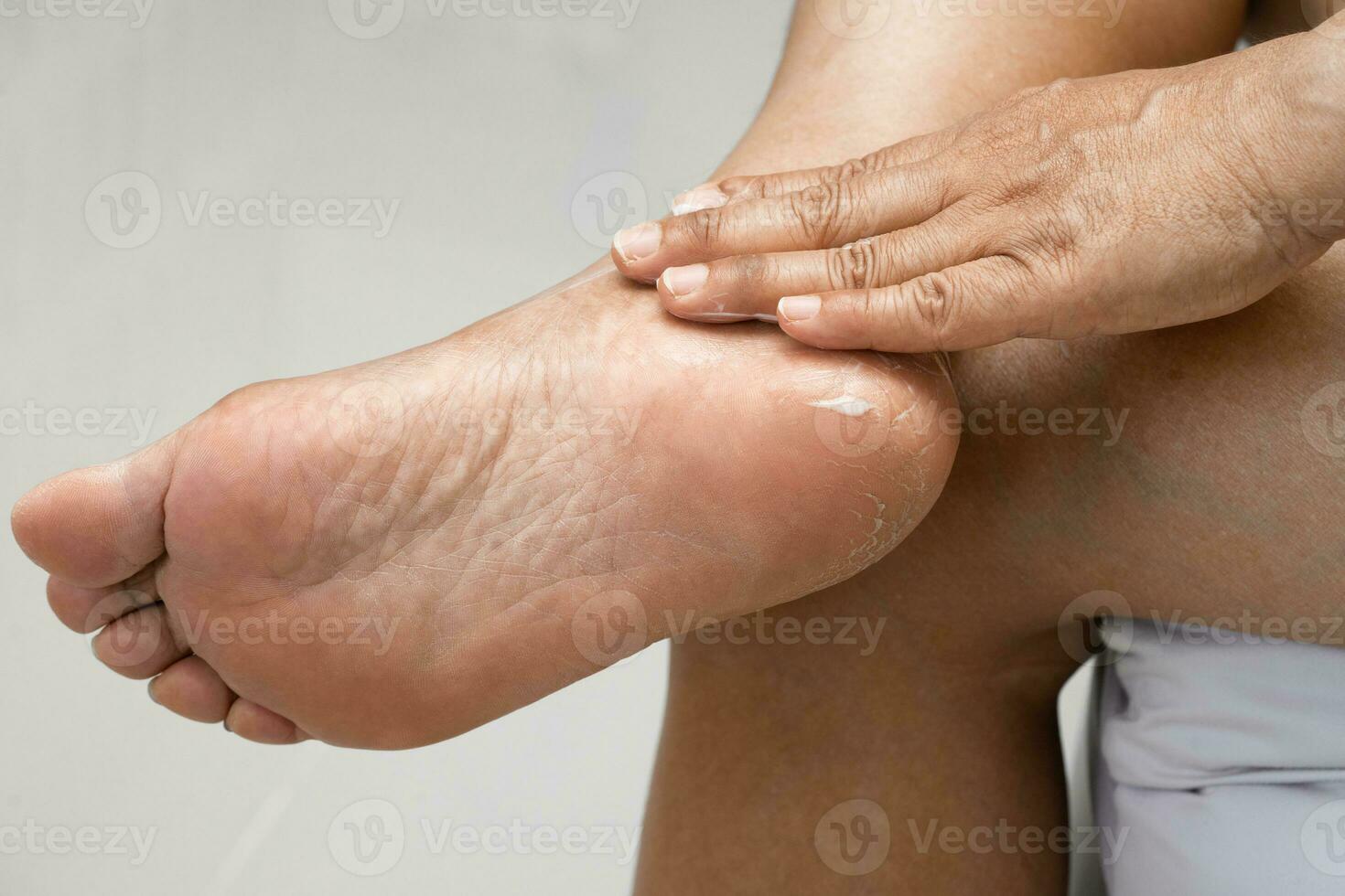 Woman care feet with cracked and dry heel skin cream at home. photo