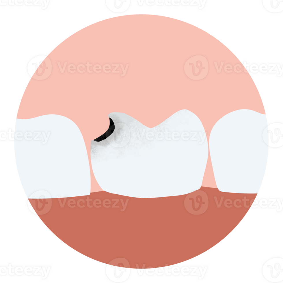 Tooth decay plaque gum disease toothache png