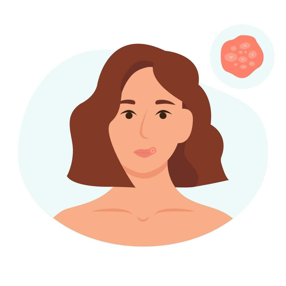 herpes en el labio de un joven mujer. inflamación de el labios. piel cuidado y salud problemas concepto. vector ilustración