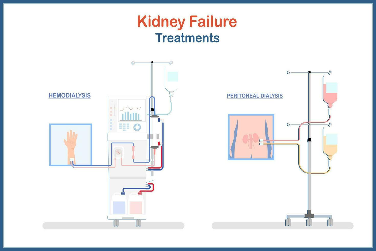 medical illustration Treatment of kidney failure. Hemodialysis and Peritoneal dialysis.Vector illustrations flat style.health care and medical concepts. vector