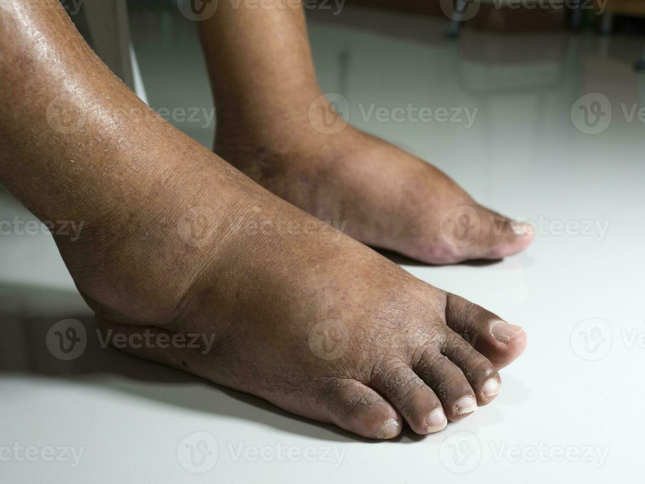 The feet of people with diabetes, dull and swollen. Due to the toxicity of diabetes placed on a white background. photo