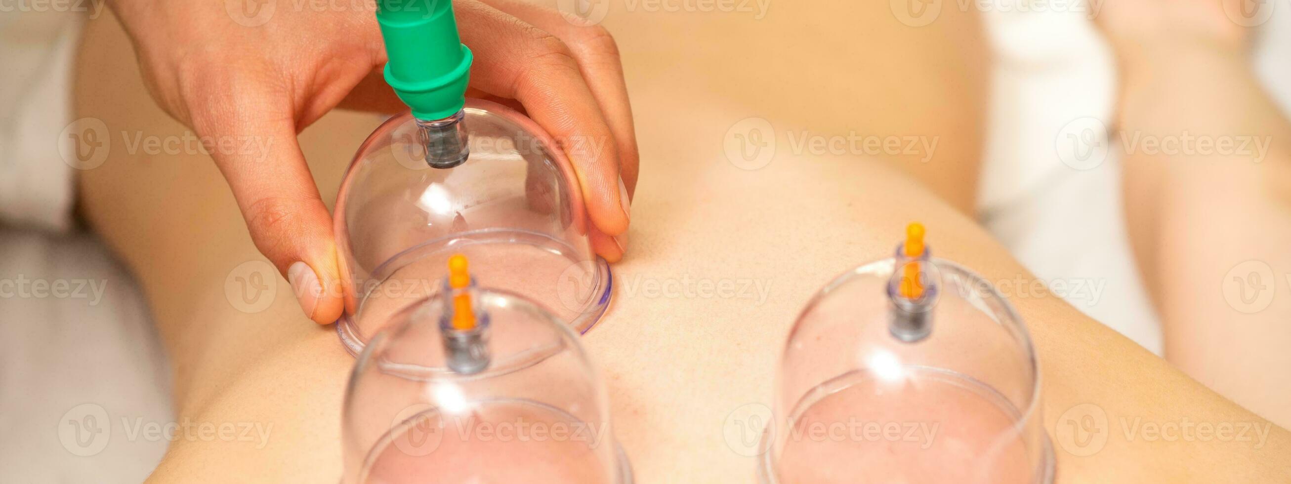 Acupuncture woman therapist placing the cup on the back of a female patient. photo