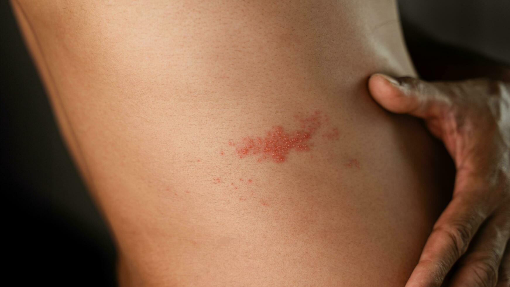 hombre con herpes enfermedad, piel infectado con herpes zóster, virus, cuidado de la salud y médico. foto