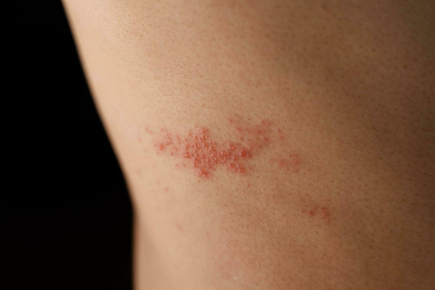 Man with shingles disease, skin infected with Herpes zoster, virus, Healthcare and medical. photo