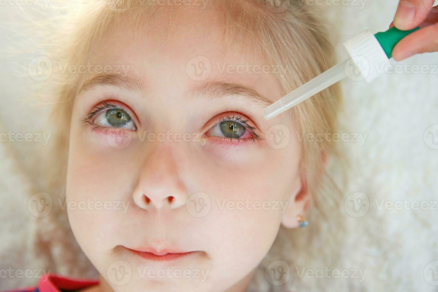 Close-up of a girl with conjunctivitis . photo