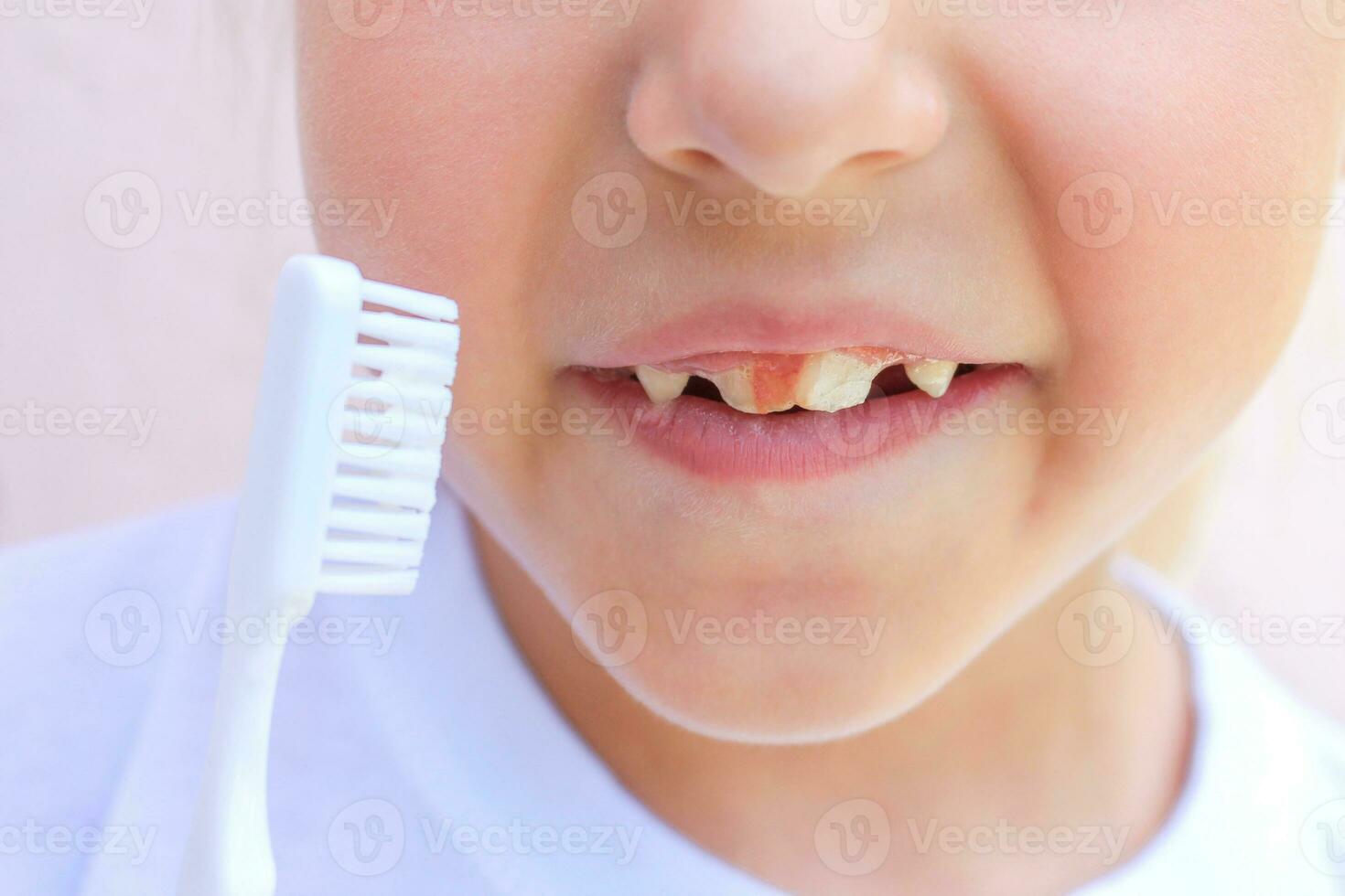 Blood on the teeth of a child. photo