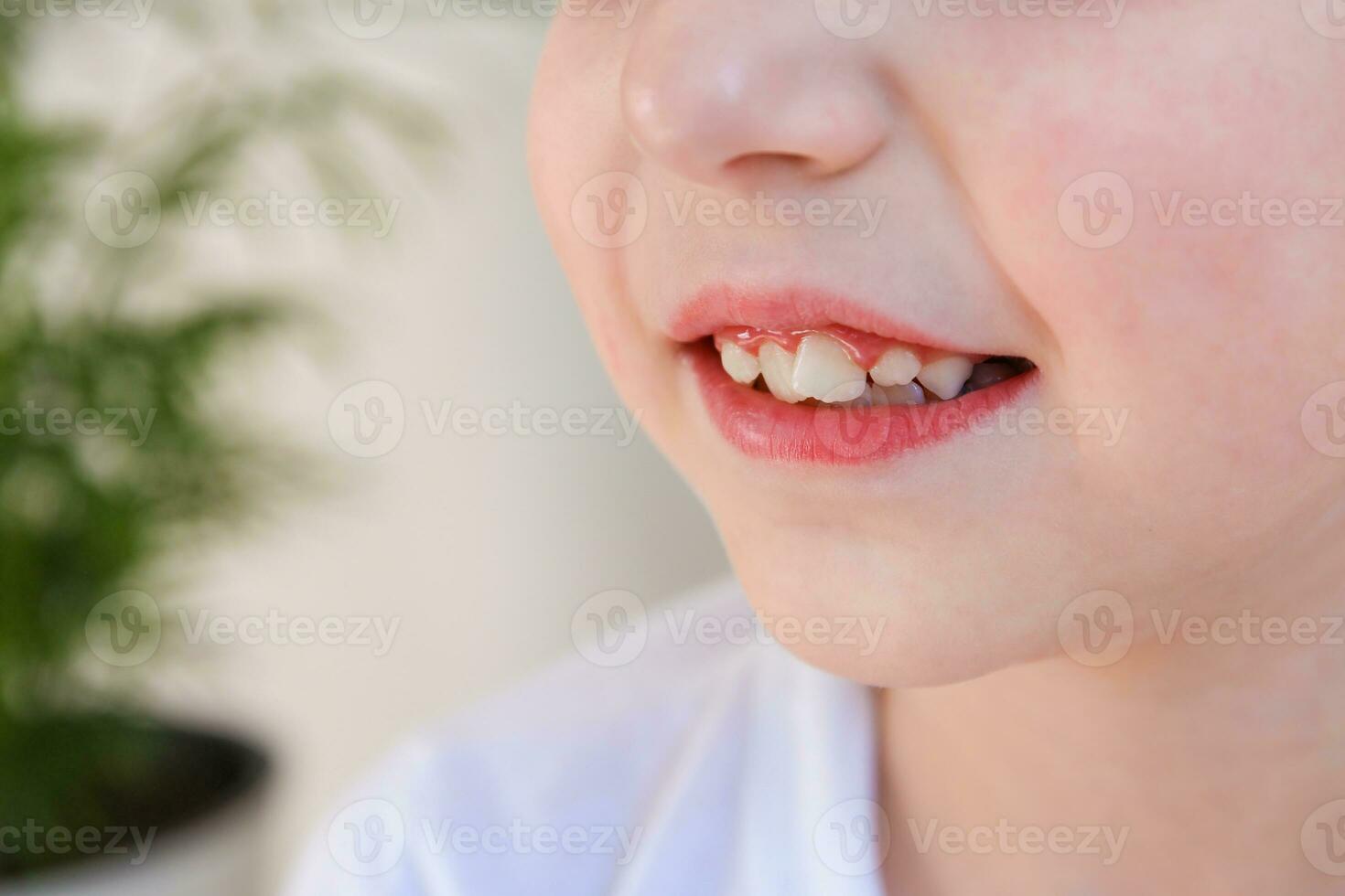 Child has crooked teeth. The concept of crowding of molars. photo
