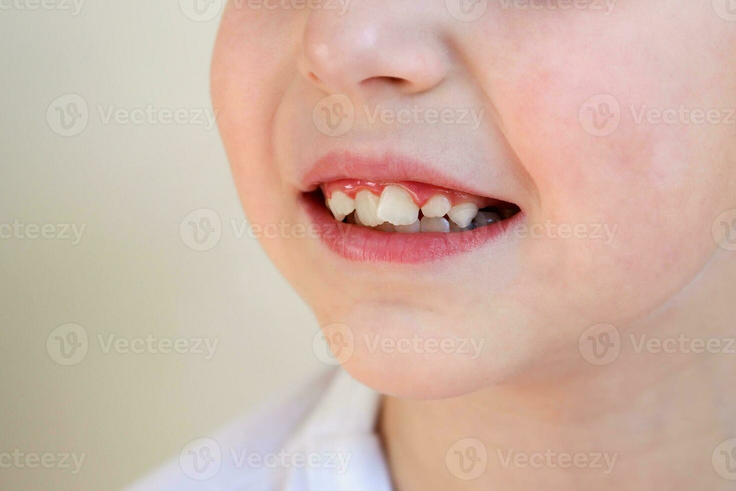 Child has crooked teeth. The concept of crowding of molars. photo