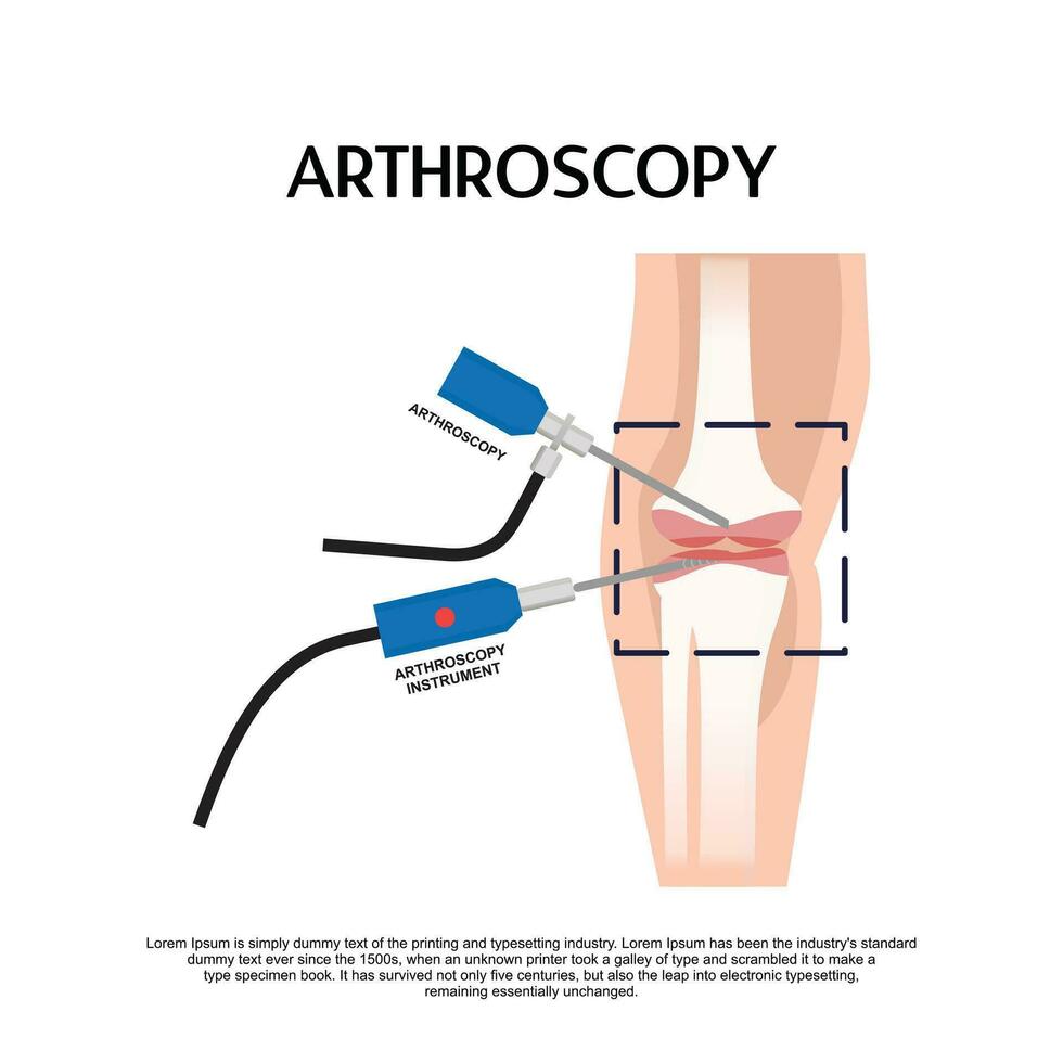 Arthroscopy medical treatment surgery keyhole surgical treat endoscope vector
