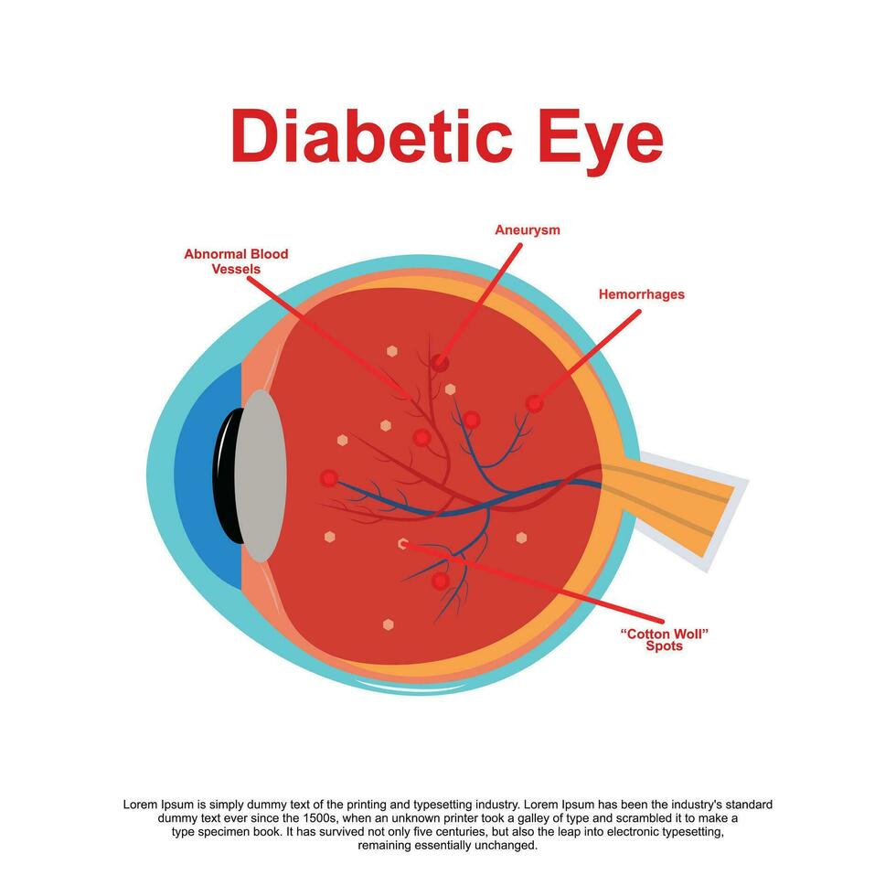 Diabetic Retinopathy vector illustration diagram, anatomical scheme.