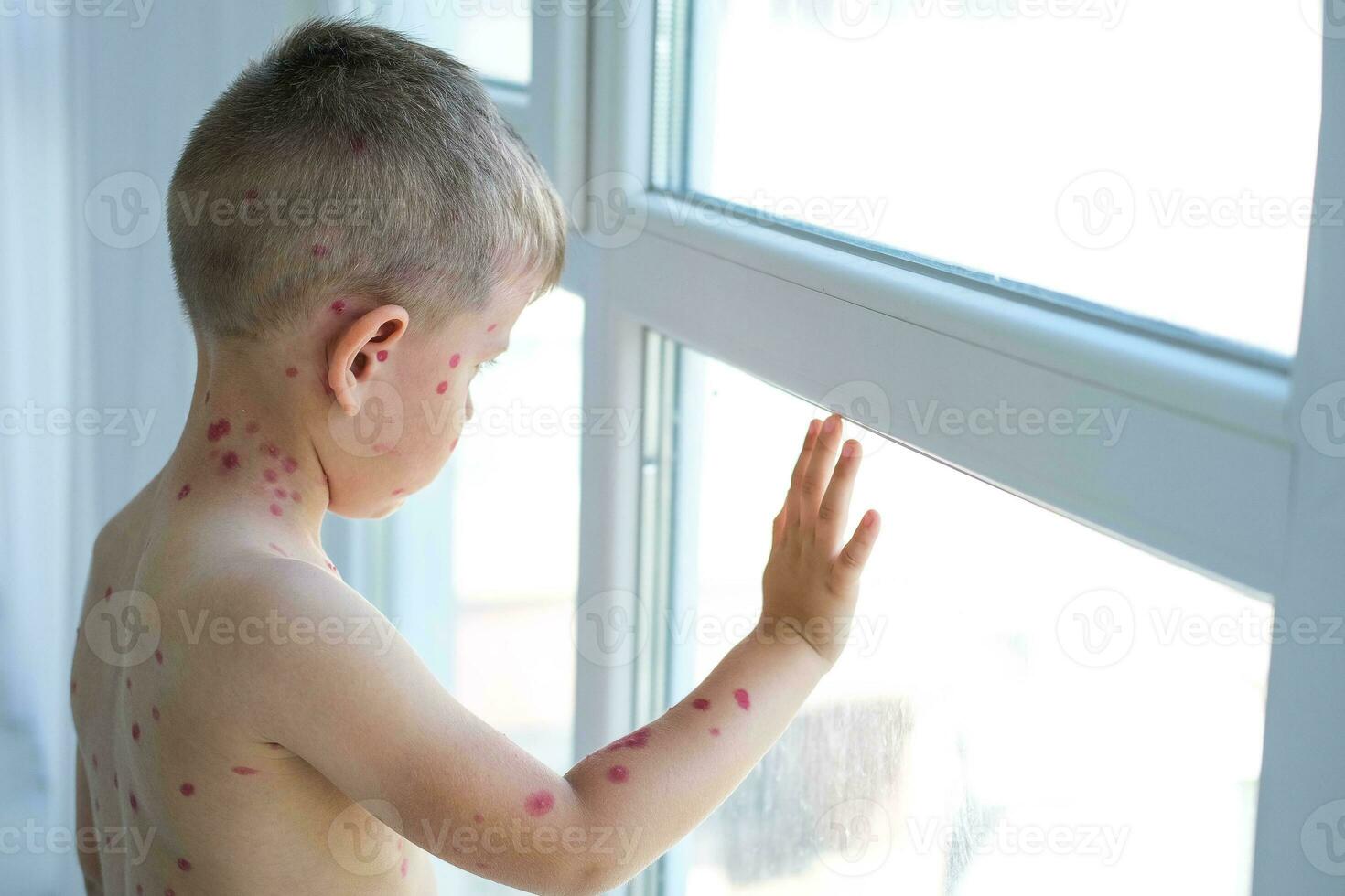 A sad boy with ulcers from chickenpox looks sadly out the window. A child treated with red medicine. Quarantine photo