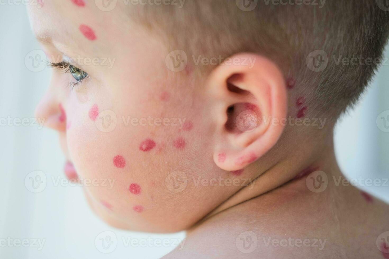 retrato de un chico con un erupción en su cara desde pollo viruela. varicela en un niño es tratado con un rojo curación crema en el niño piel. foto