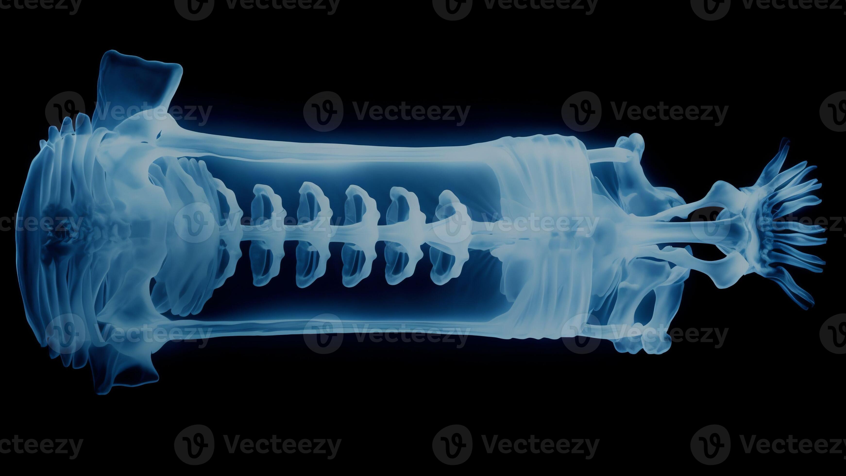 AI Generative Xray image in a hospital of a broken arm with metal pins