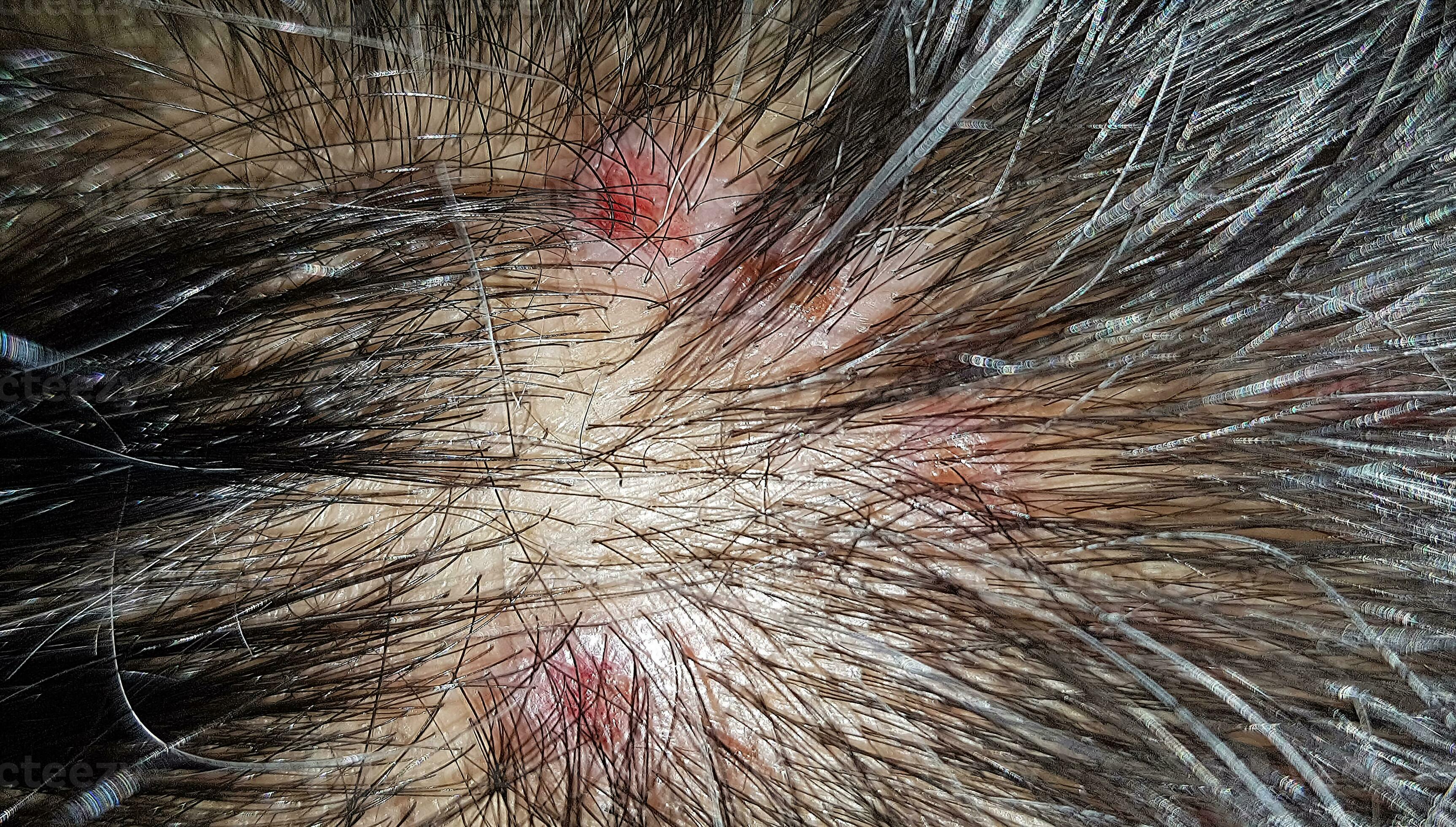 Scab Picking Scalp scab-picking-scalp