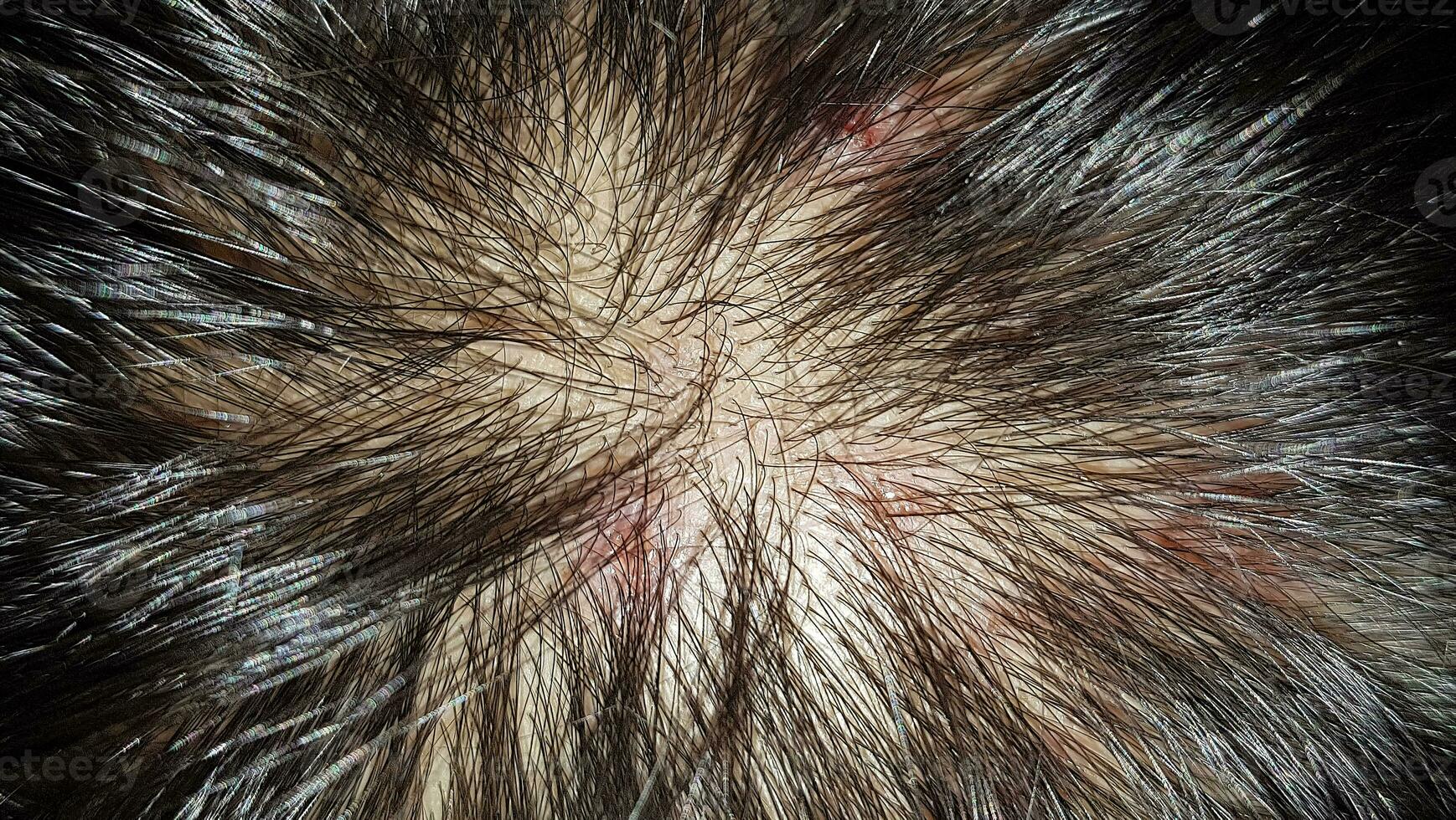 Scabs On The Scalp, wound on the scalps or Lichen planus follicularis capillitii, itch on the scalps photo