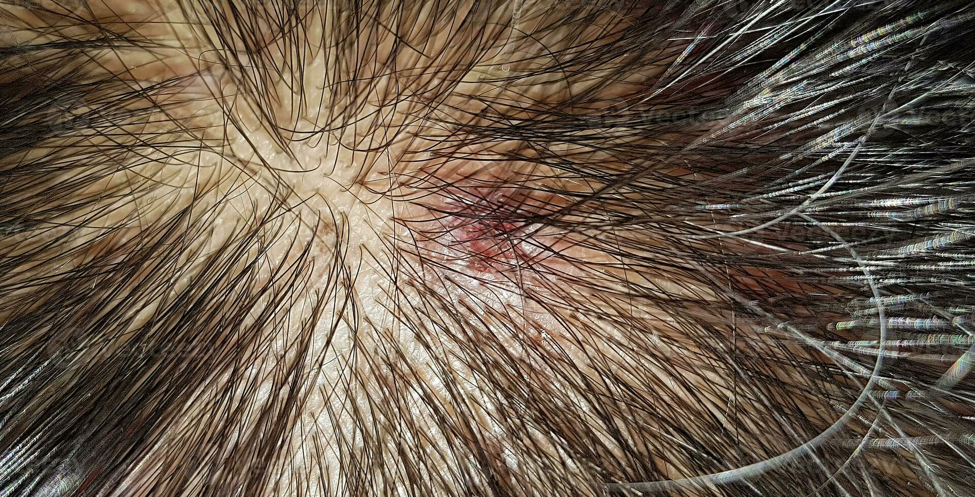 Scabs On The Scalp, wound on the scalps or Lichen planus follicularis capillitii, itch on the scalps photo