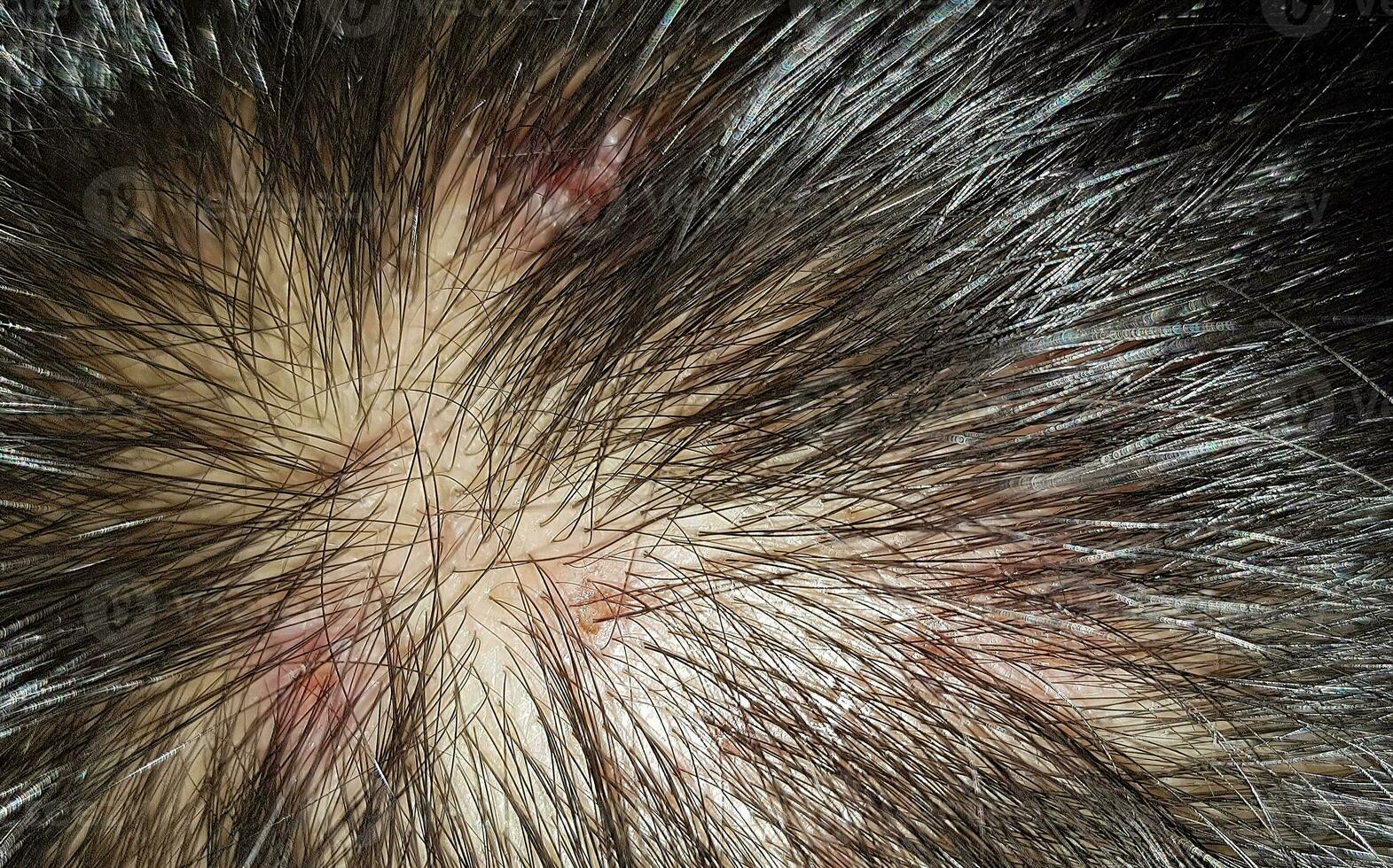 Scabs On The Scalp, wound on the scalps or Lichen planus follicularis capillitii, itch on the scalps photo