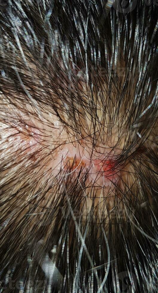Scabs On The Scalp, wound on the scalps or Lichen planus follicularis capillitii, itch on the scalps photo