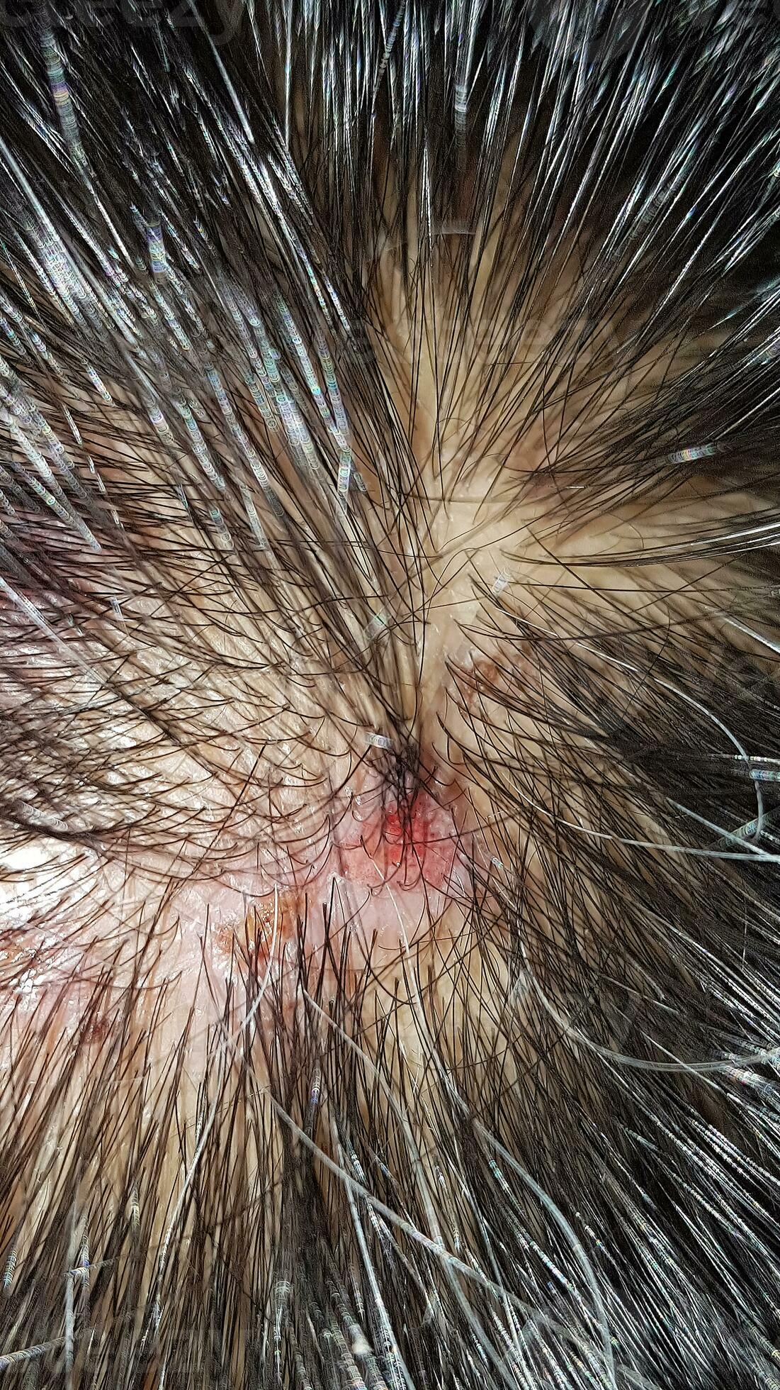 Scabs on Scalp: Everything You Need to Know - Wimpole Clinic