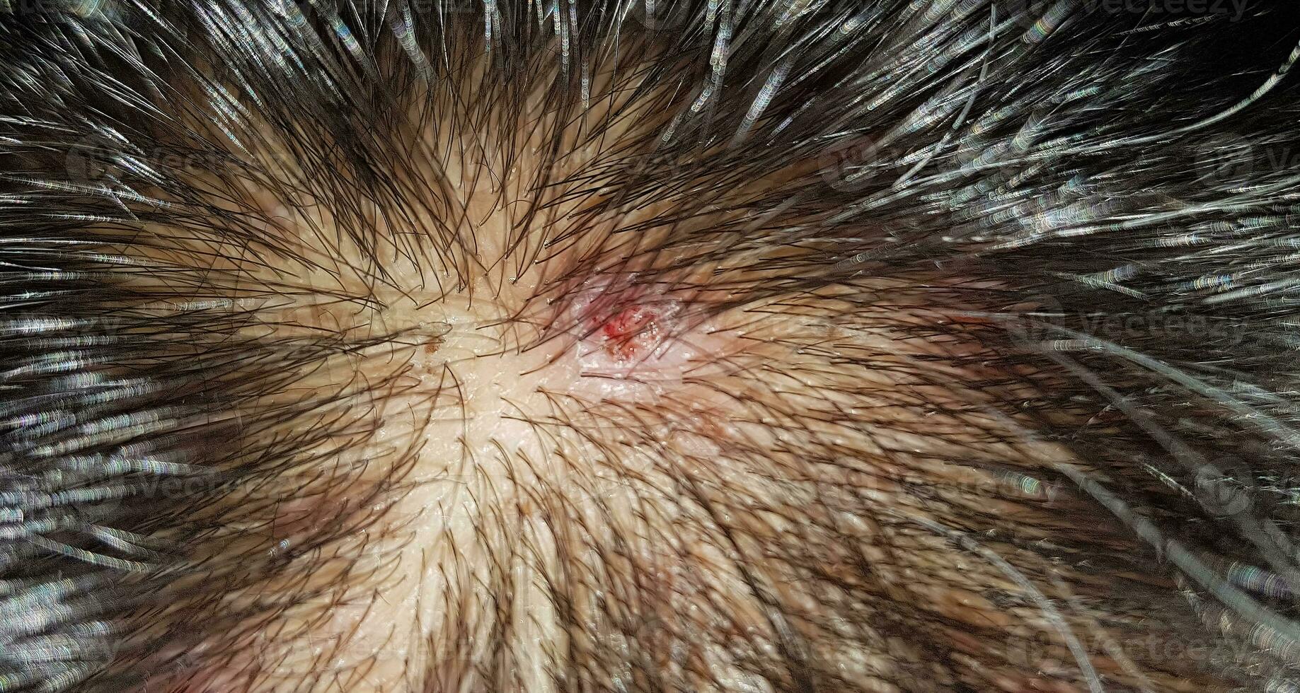 Scabs On The Scalp, wound on the scalps or Lichen planus follicularis capillitii, itch on the scalps photo