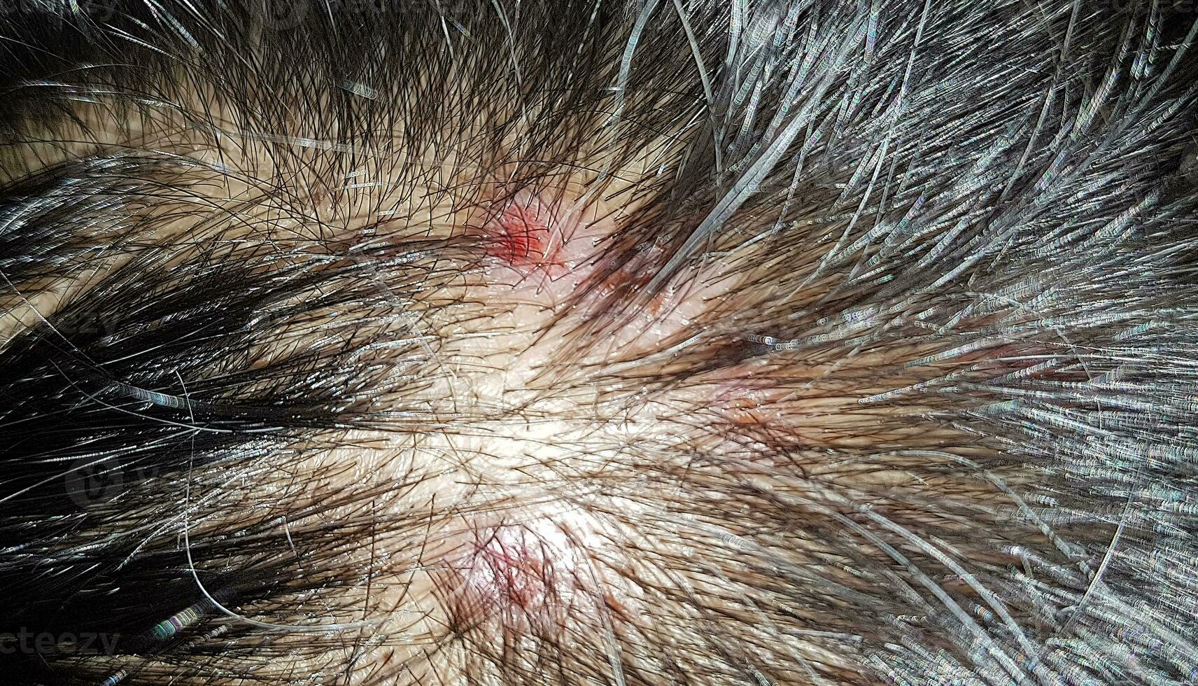 Scabs On The Scalp, wound on the scalps or Lichen planus follicularis capillitii, itch on the scalps photo