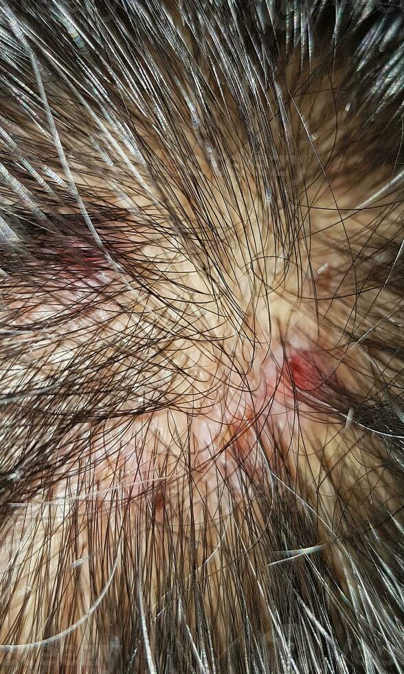 Scabs On The Scalp, wound on the scalps or Lichen planus follicularis capillitii, itch on the scalps photo