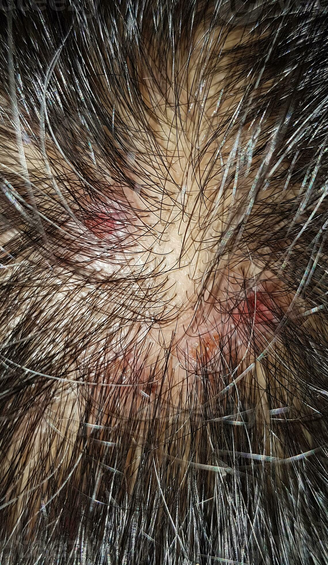 Scabs on Scalp: Everything You Need to Know - Wimpole Clinic