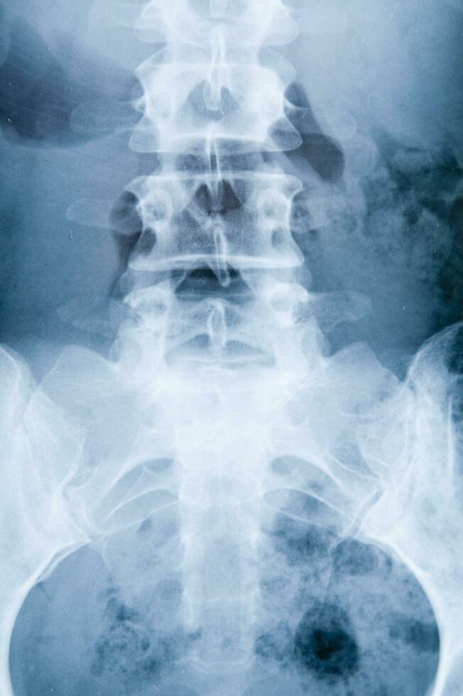 a x - ray image of a person's back photo