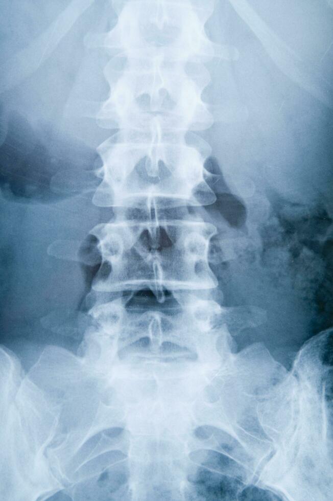 a x - ray image of a person's back photo