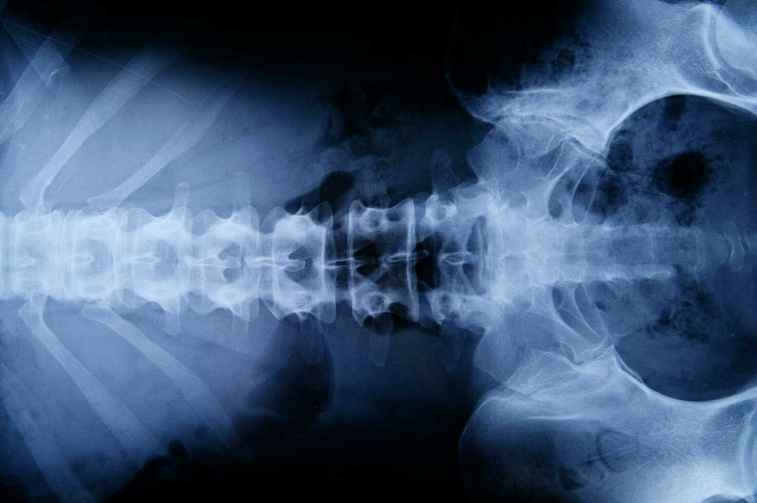 a x - ray image of a person's back photo