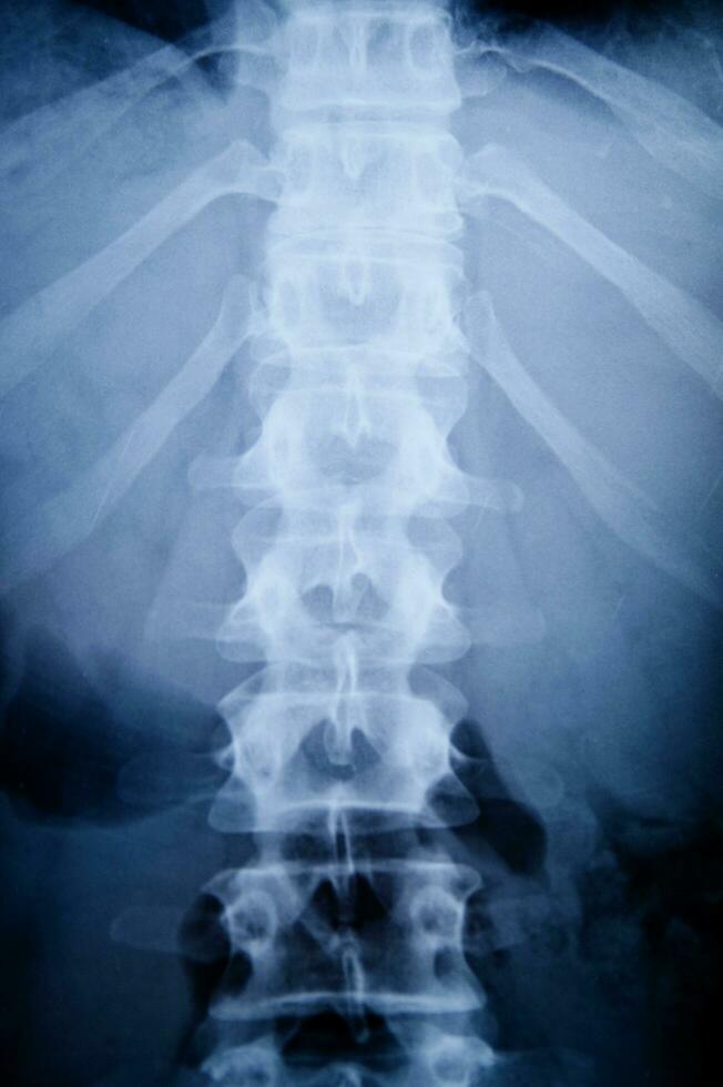 a x - ray image of a person's back photo