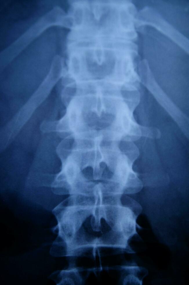 a x - ray image of a person's back photo