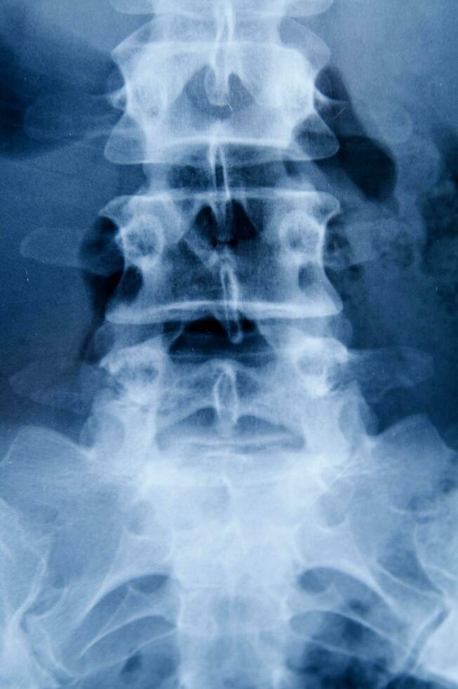 a x - ray image of a person's back photo