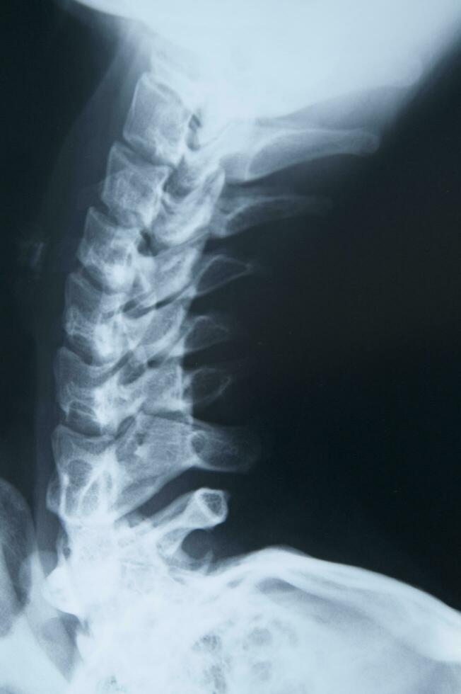 a x - ray image of a person's back photo