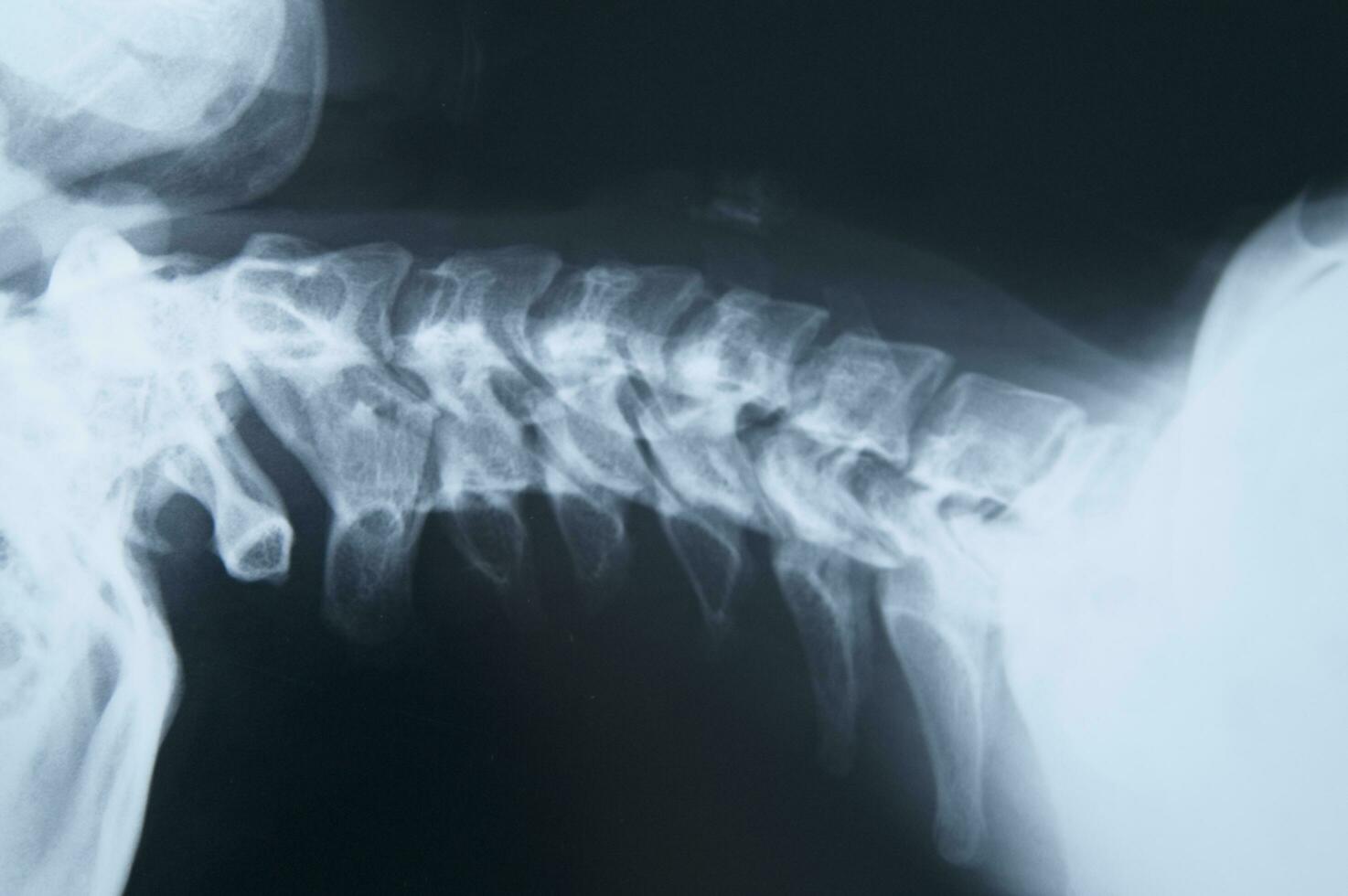 a x - ray image of a person's back photo