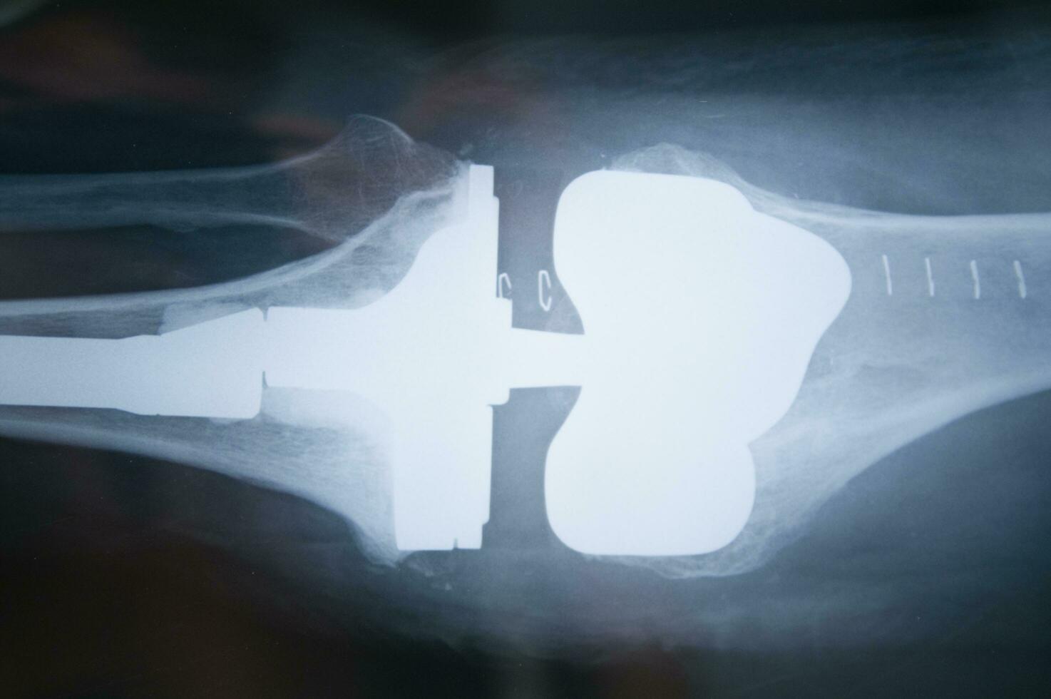 a x - ray image of a person's back photo